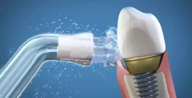 Mejor Irrigador Dental para Implantes