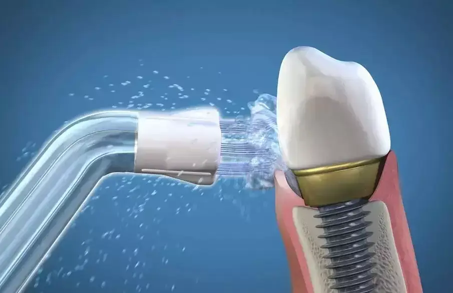 El mejor irrigador dental para implantes