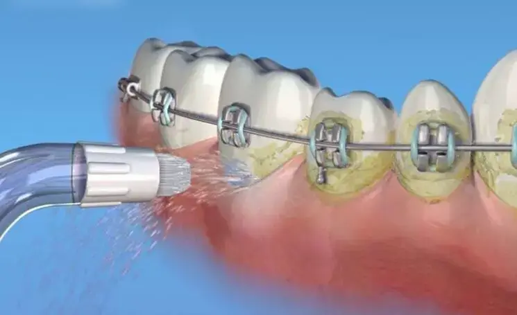 Los mejores irrigadores dentales para ortodoncia