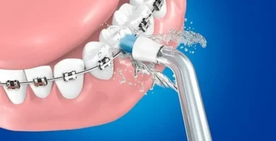 Irrigador Dental Ortodoncia Brackets