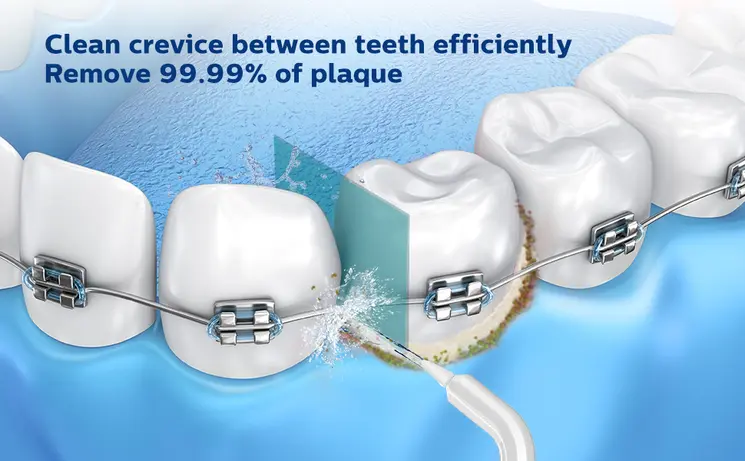 Le explicamos como usar un irrigador dental para brackets